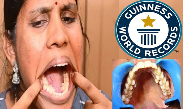 38 दांतों वाली भारतीय महिला गिनीज वर्ल्ड में