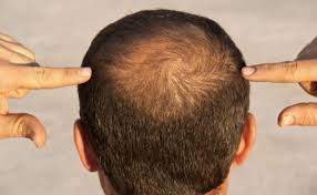 गंजे सिर में उगने लगेंगे नए बाल बस करें ये एक काम 