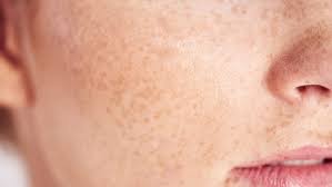 चेहरे की झाइयों से छुटकारा दिलाएंगे ये देसी उपाय