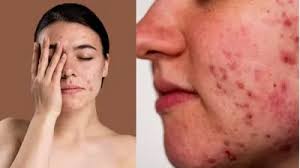 आपकी इन आदतों से बढ़ सकते हैं चेहरे पर पिंपल्स, आज ही छोड़ दें
