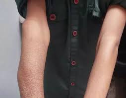 गंभीर लापरवाही : फोन पर एक्स-रे देख कर दिया 9 साल के बच्चे का प्लास्टर,एक महीने बाद खोला तो उड़ गए होश